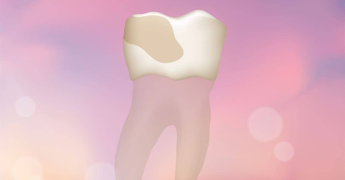 Tooth Erosion: Effective Strategies to Preserve Your Smile from Acid Damage