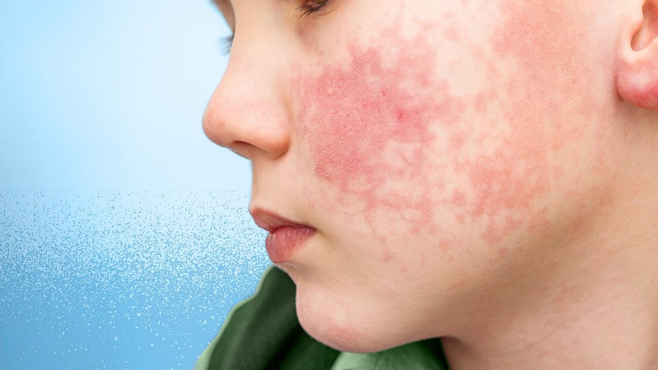 'Slapped Cheek' (Fifth Disease) Virus: Essential Facts You Need to Know